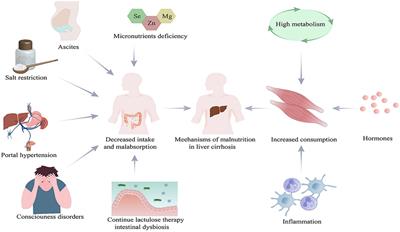 Screening and assessment of malnutrition in patients with liver cirrhosis